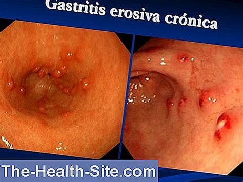 Gastritis  Gastritis : Síntomas, Causas  Científico Práctico Medical ...