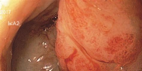 Gastritis hemorrágica inducida por radiación  gastritis actínica ...