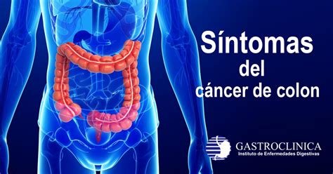 GASTROCLINICA | Síntomas del cáncer de colon