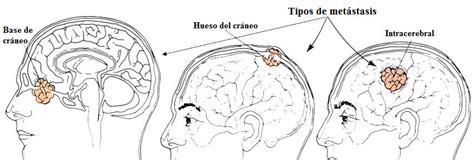 Generalidades Tumores Cerebrales – Clínica Neuros ...