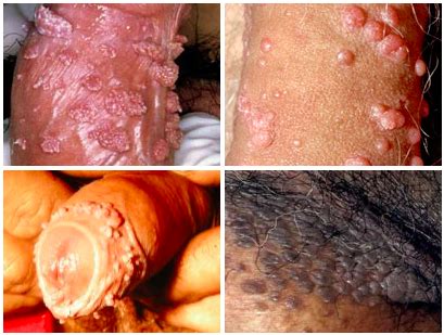 Genital Warts Treatments   Causes And Symptoms | LSAH Clinic