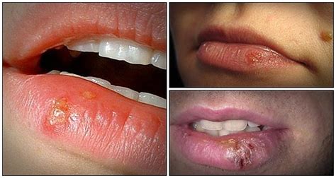 Get to Know 13 Tips on How to Get Rid of Cold Sores ...