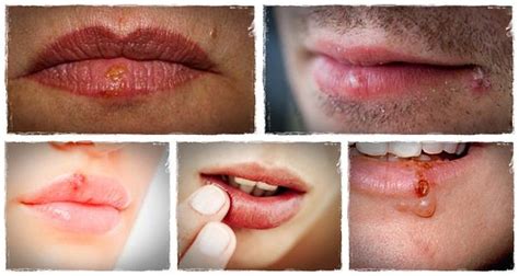 Get to Know 13 Tips on How to Get Rid of Cold Sores ...