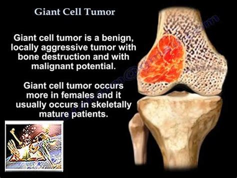 Giant Cell Tumor   Everything You Need To Know   Dr. Nabil ...
