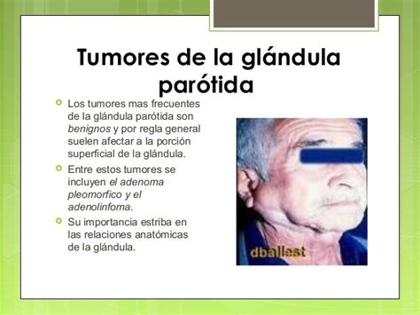 Glandula parotida 5 1