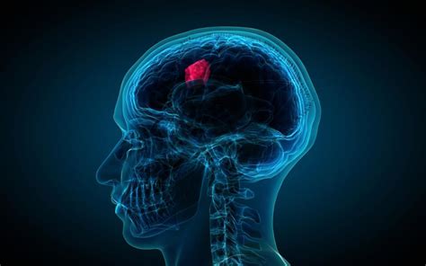 Glioblastoma: A new treatment for this deadly brain tumor?