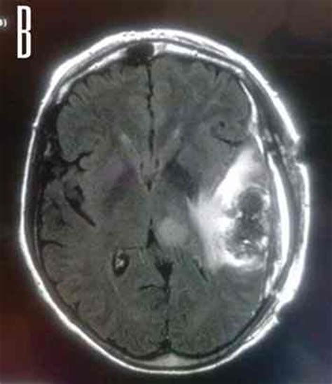 glioblastoma cerebral