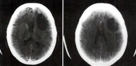 Glioblastoma Multiforme en Paciente Anciano · Revista ...