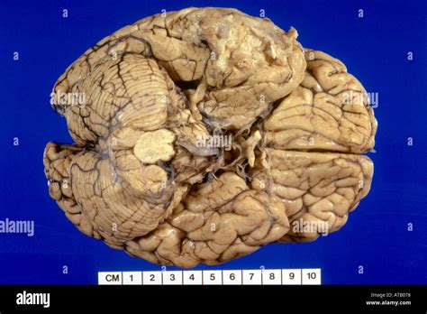 Glioblastoma Multiforme Fotos e Imágenes de stock   Alamy