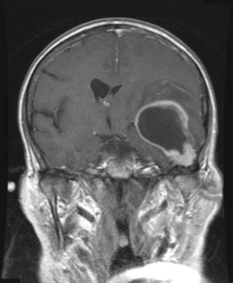 Glioblastoma multiforme MRI   wikidoc