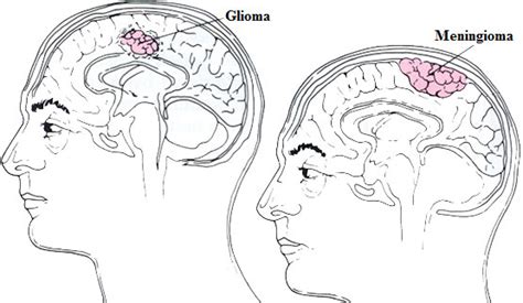 Glioblastoma Multiforme – Clínica Neuros | Neurocirujano ...