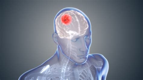 Glioblastoma: The Cancer of Brain   Scientific Animations