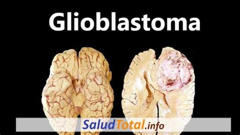 Glioblastoma ¿Un Nuevo Tratamiento para este Tumor ...