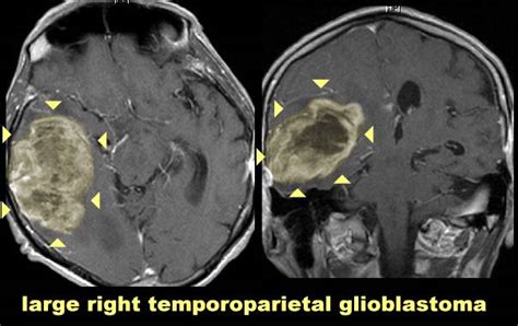 : Gliomas y glioblastoma multiforme. Información; síntomas ...