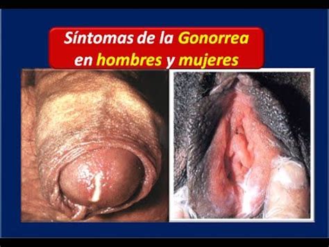 GONORREA: Sintomas de la Gonorrea en hombres y mujeres ...