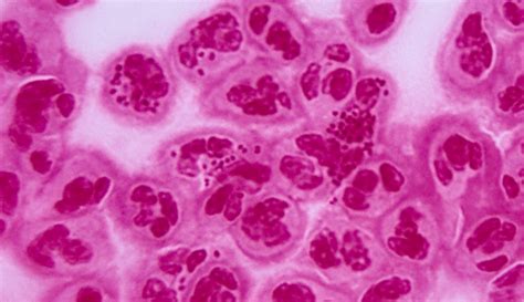 Gonorrhea Infects Multiple Body Parts | BlackDoctor