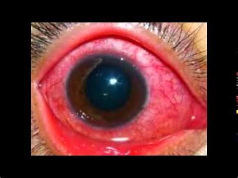 Gonorrhea Of The Eye Pictures   YouTube