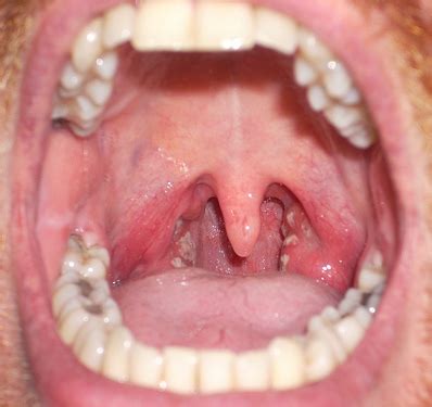 Gonorrhea Throat   Symptoms, Treatment, Causes, Pictures ...