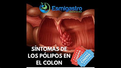 Grados Cancer De Colon   SEONegativo.com