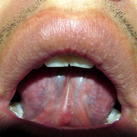 Granos en labios y bulto bajo la lengua – dermatologo.net
