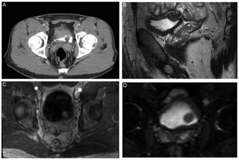 Granular Cell Tumor of the Bladder: A Rare Neoplasm ...