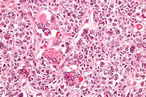 Granulosa cell tumour   Wikipedia