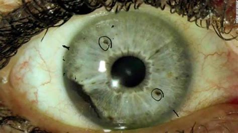 Group of rare eye cancer cases baffles experts   CNN