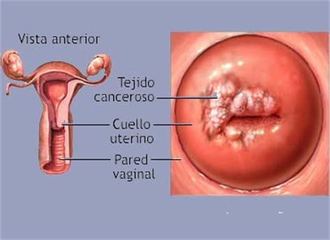 Guia de la Mujer y Embarazo: virus del papiloma humano