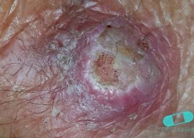 Guía de la piel Carcinoma de Células Escamosas