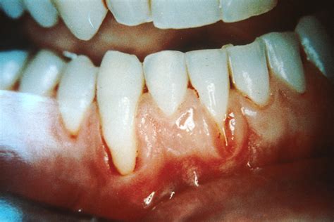 Gum Cancer   Causes, Symptoms, Treatment, Pictures, Signs ...