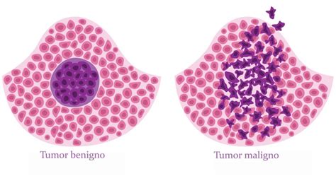 Há ligação entre tumor benigno e hematológico?  Revista Online ABRALE
