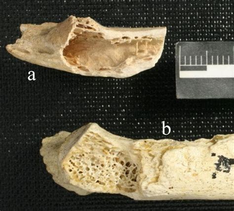 Hallan el cáncer de huesos más antiguo en un Neanderthal ...