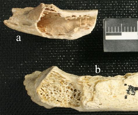 Hallan en un Neanderthal el cáncer de huesos más antiguo ...