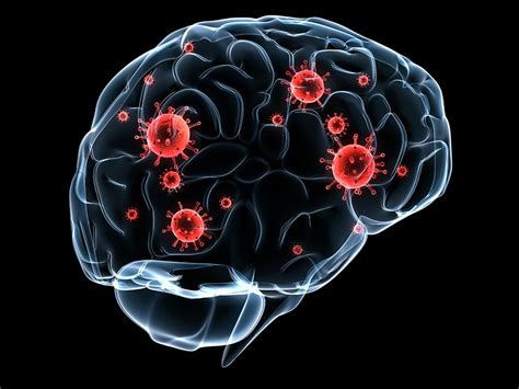 Hallan Nuevo Método Para Tratar Las Metástasis Cerebrales ...
