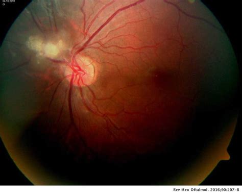 Hamartoma astrocítico retiniano: manifestación ocular de esclerosis ...