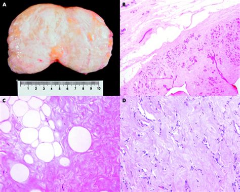 Hamartoma of the breast: a clinicopathological review | Journal of ...