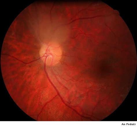 Hamartoma retiniano en esclerosis tuberosa | Anales de Pediatría