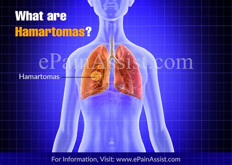 Hamartomas|Causes|Symptoms|Treatment|Types|Locations|Can it Spread?