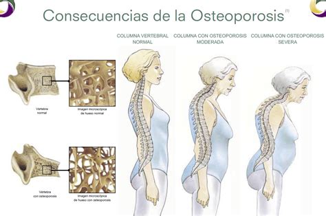Hay más fracturas por osteoporosis que la suma de infartos ...