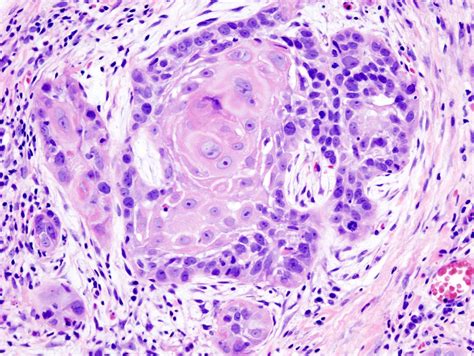 Head and neck squamous cell carcinoma Wikipedia