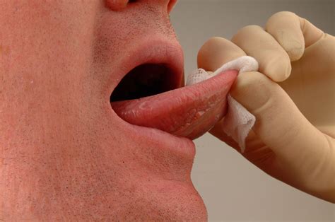 Health Topics Blogs : Mouth Cancer Lip