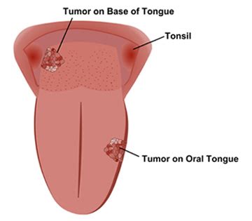 healthtipsbyeswar: stages of Tongue Cancer
