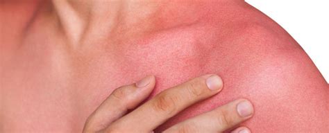 Heat rash, sun rash    what s the difference? | OSF HealthCare