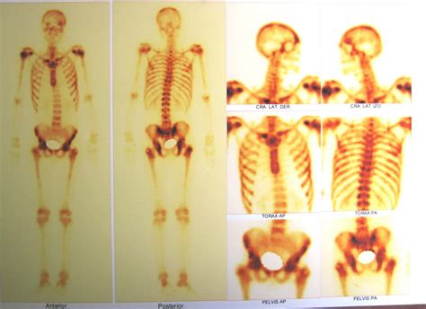 HEMATOCIENCIAS: CANCER DE PROSTATA, METASTASIS OSEA ...