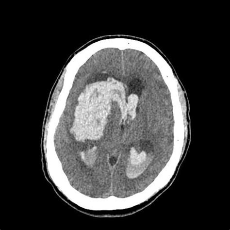 Hemorrhagic stroke CT   wikidoc