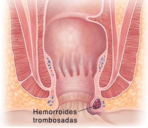 Hemorroides trombosadas  con trombos
