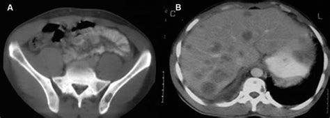 Hemotórax espontáneo por carcinoma broncogénico | Archivos ...