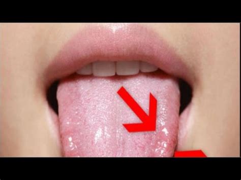 Herpes en la lengua: ¿qué es?, causas, síntomas, tratamiento y más