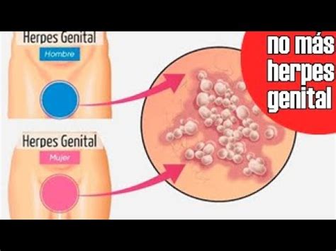 Herpes genital, porque salen granos en la pelvis   YouTube