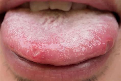Herpes on Tongue: Learn about Risks, Causes and Treatment